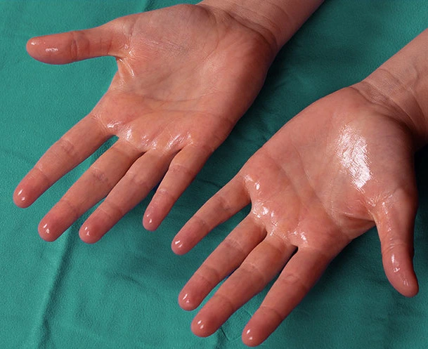 Excessive sweating hands before Hidroxa iontophoresis treatment