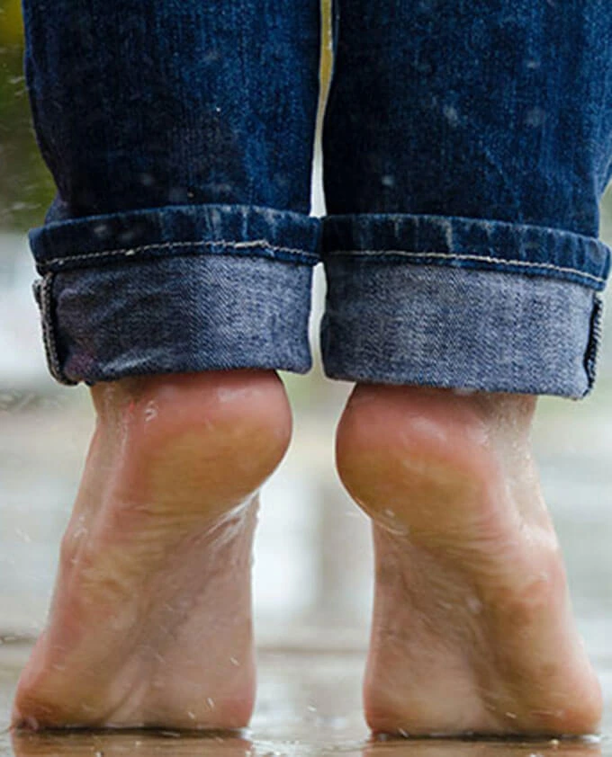 Plantar hyperhidrosis feet sweating before Hidroxa iontophoresis treatment