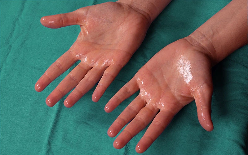 Sweating hands caused by palmar hyperhidrosis before Hidroxa iontophoresis treatment