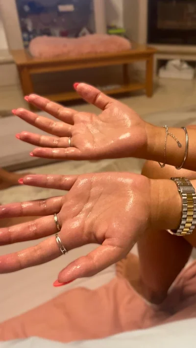 Sweaty palms caused by palmar hyperhidrosis before Hidroxa iontophoresis treatment