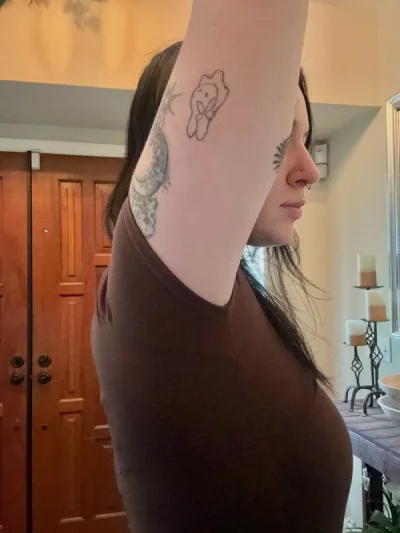 Dry underarms after Hidroxa iontophoresis treatment for hyperhidrosis