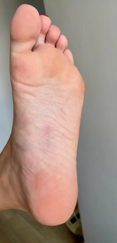 dry foot after successful Hidroxa iontophoresis treatment for plantar hyperhidrosis
