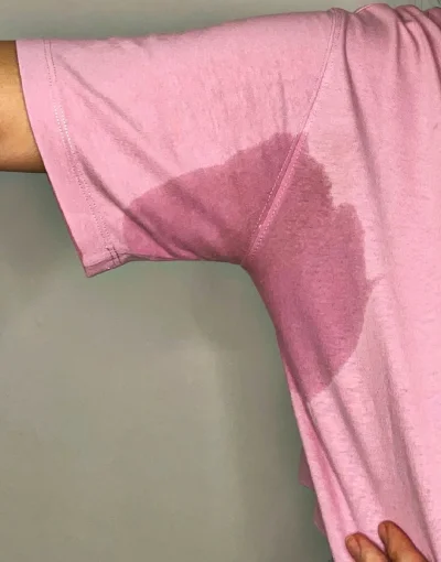 Large underarm sweat stain caused by axillary hyperhidrosis before Hidroxa iontophoresis treatment
