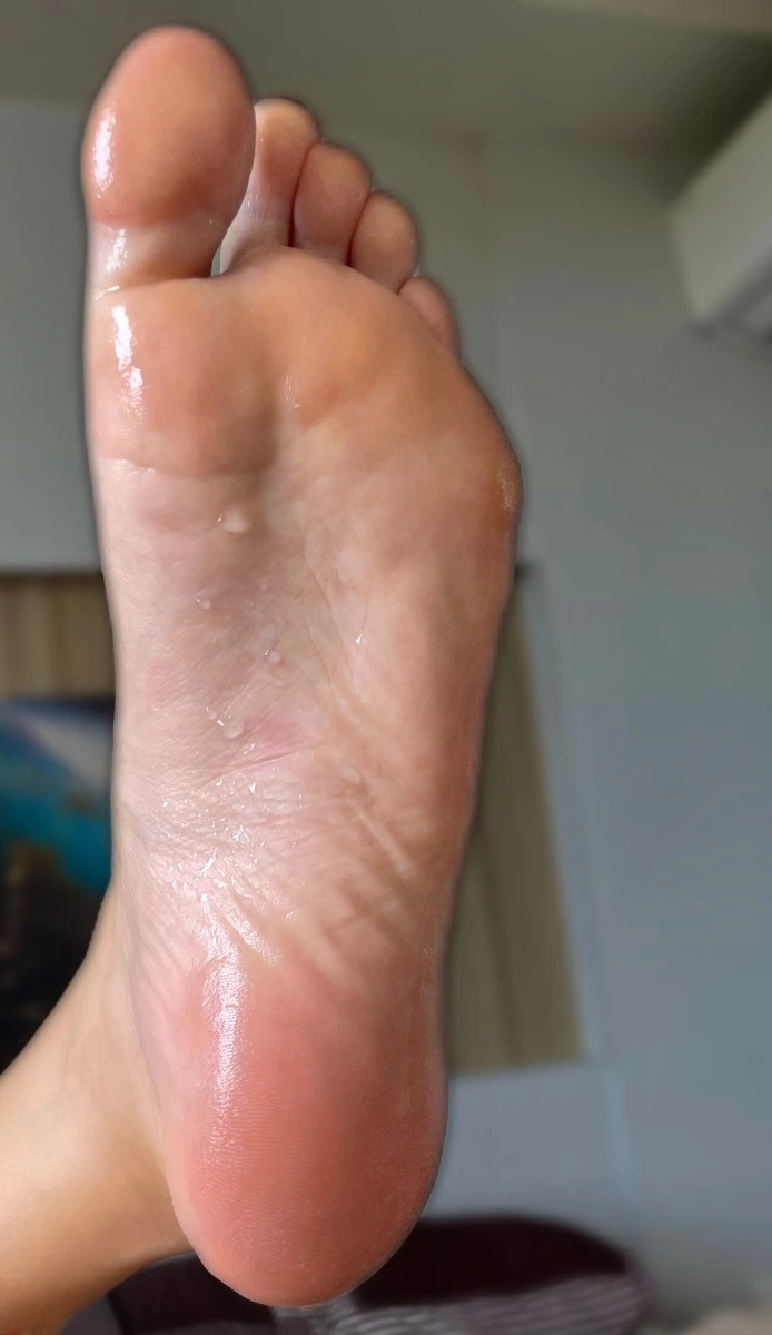 sweaty foot caused by plantar hyperhidrosis before Hidroxa iontophoresis treatmen