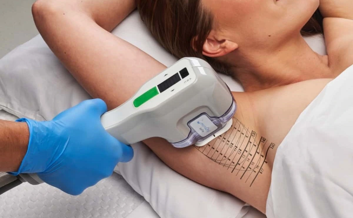 MiraDry treatment for hyperhidrosis